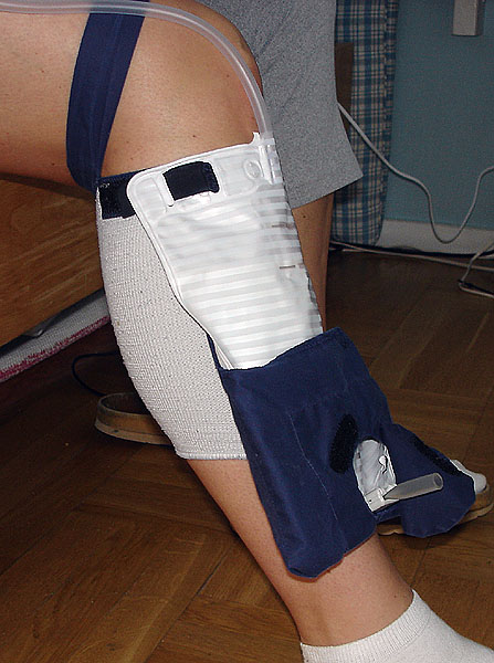 Customized holder sitting on lower leg with urine bag