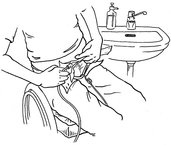 Användaren kopplar ihop katetern och urinpåsen. Illustration: Lars 'Geson' Andersson